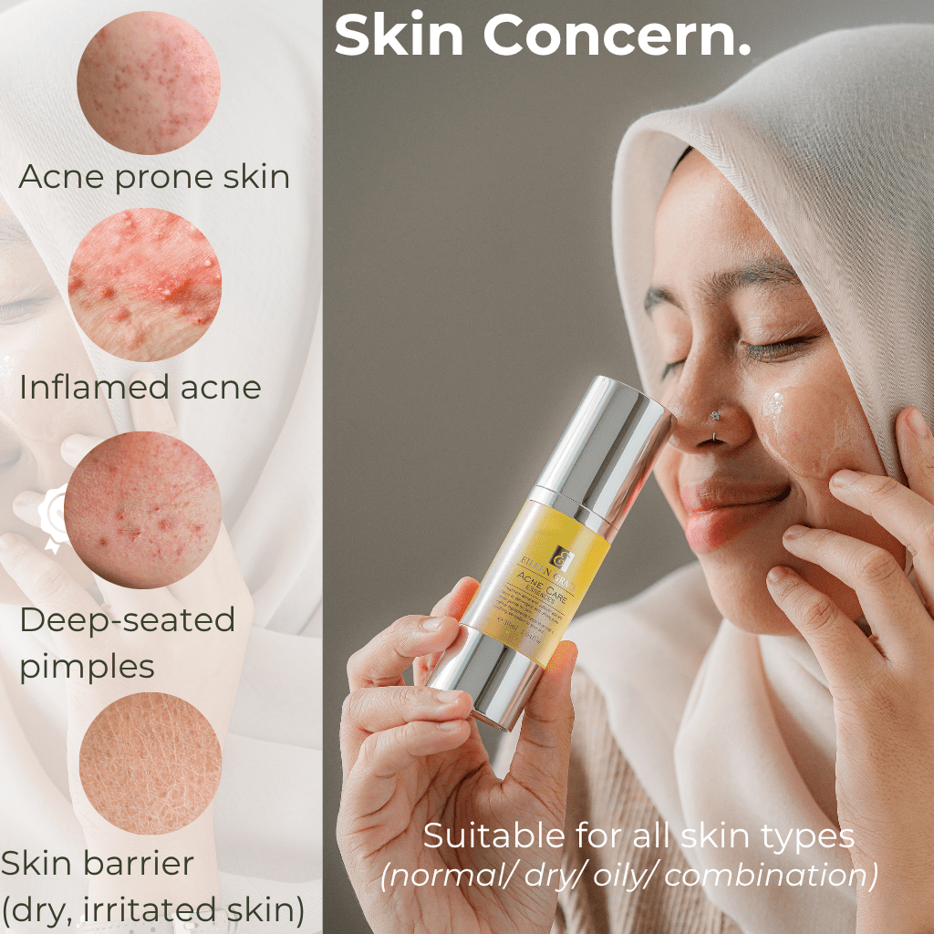 Eileen Grace Acne Care Essence 30ml – Fast - Acting Serum for Pimples | Best Acne Treatment in Malaysia - Eileen Grace Malaysia Official Store
